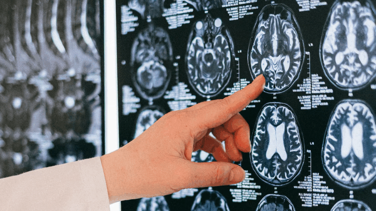 Mayo Clinic investiga estimulación cerebral profunda para frenar convulsiones