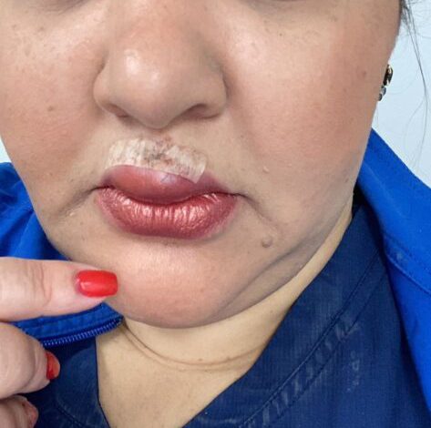 “Brutal agresión en hospital: padre de paciente muerde y hiere gravemente a emergencióloga en Santo Domingo Este”