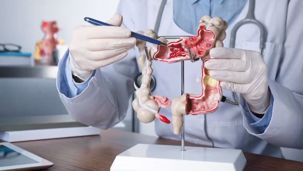 Especialistas alertan sobre aumento de cánceres gastrointestinales en jóvenes